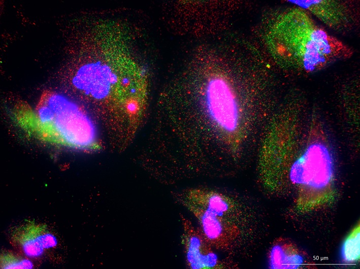 TDP-43 mislocalization in iPSC-derived ,motor neurons